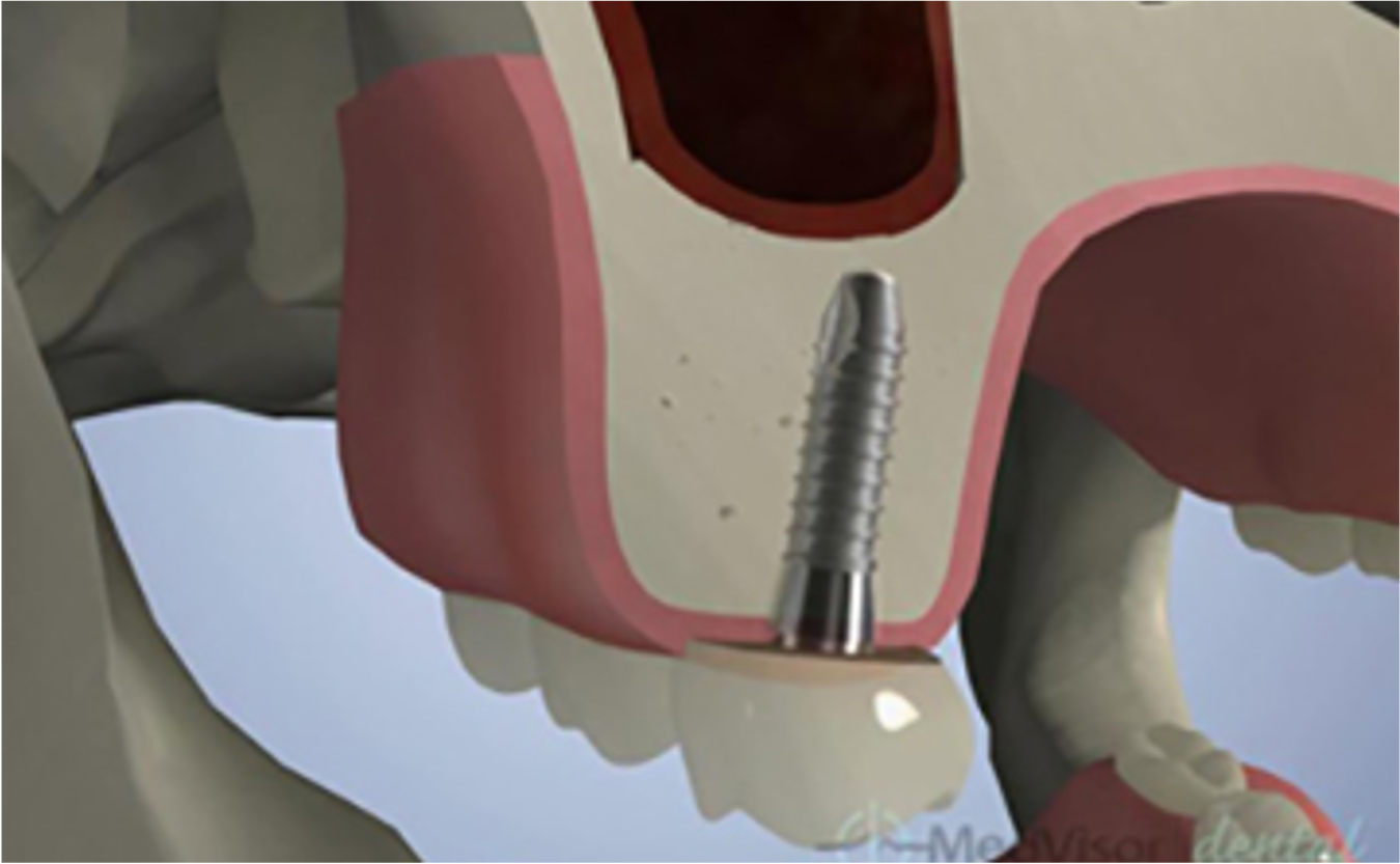 麻布十番の歯医者のインプラント治療の骨移植のイメージ