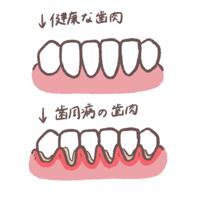 健康な歯ぐきと歯周病になった歯ぐきの状態の比較イラスト