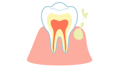 歯ぐきから膿がでているイラスト