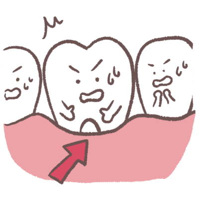 歯ぐきの炎症の進行により歯ぐきが下がり歯根が露出しているイラスト