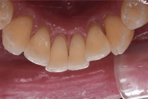 歯石除去（SC）