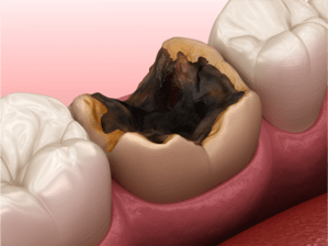 神経まで達した深い虫歯を表した口腔内のイメージ画像