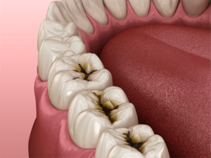 浅い虫歯の口腔内の状態をあらわしたイメージ画像