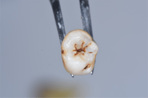 C1は浅い虫歯で抜歯後の歯の写真