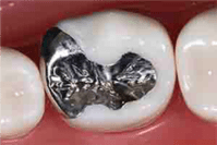 麻布十番の歯医者さんでシルバーインレーを詰めた状態のイメージ