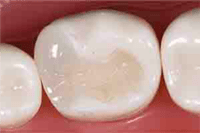 麻布十番の歯医者さんでジルコニアセラミックインレーを詰めた状態のイメージ