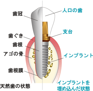 C4の歯を抜歯後インプラントを行う際の口内の構造を説明したイメージ図