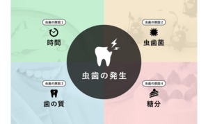時間・細菌・歯の質・糖分による虫歯の発生メカニズムのイメージ図
