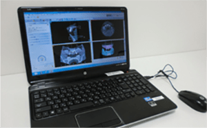 麻布十番の歯医者さんでインプラント無料相談の前に撮影するレントゲン写真のPC画面のイメージ