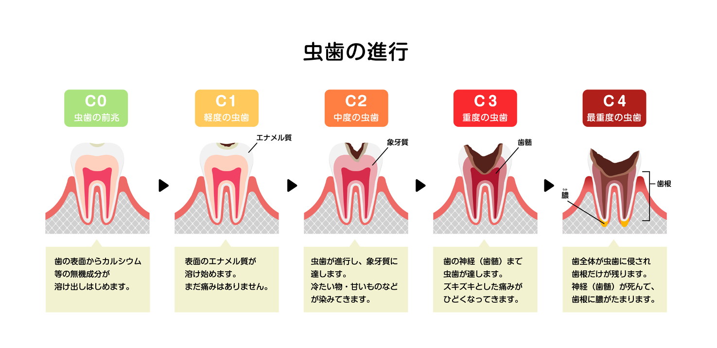 虫歯の前兆から最重度の虫歯までの流れのイメージ図