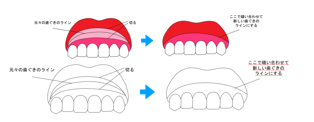 歯ぐきを切開・縫合のイラスト