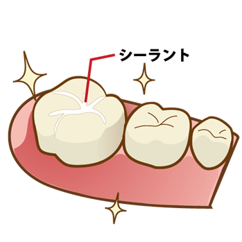シーラント処置を行った歯のイラスト