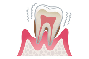 歯周病