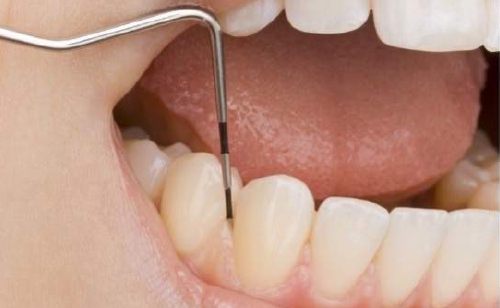 麻布十番の歯医者さんで歯の汚れを歯科用器具で取り除いているイメージ