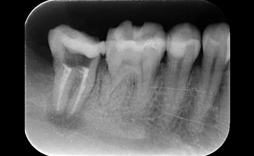 麻布十番の歯医者さんで歯石除去を行っているイメージ
