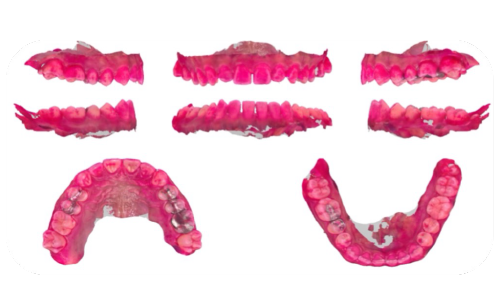 麻布十番の歯医者さんで歯石除去を行っているイメージ